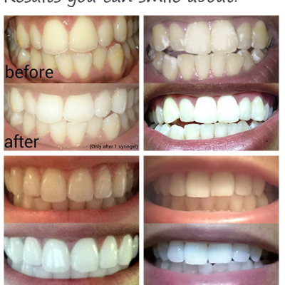 SmileBrilliant Teeth Whitening System!